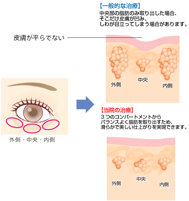 【一般的な治療】 中央部の脂肪のみ取り出した場合、そこだけ皮膚が凹み、しわが目立ってしまう場合があります。 【当院の治療】 3つのコンパートメントからバランスよく脂肪を取り出すため、滑らかで美しい仕上がりを実現できます。