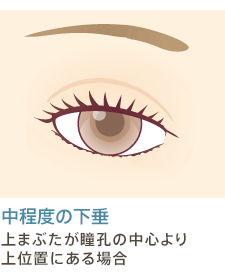 中度の下垂 上まぶたが瞳孔の中心より上位置にある場合