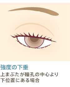 強度の下垂 上まぶたが瞳孔の中心より下位置にある場合