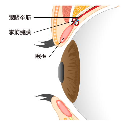 より確実な「腱膜縫縮法」