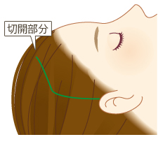 髪の毛の中 切開部分 イメージ図