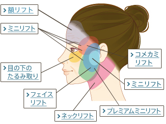 リフト施術の種類