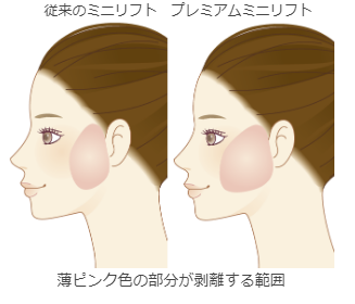 従来のミニリフト プレミアムミニリフト 薄ピンク色の部分が剥離する範囲