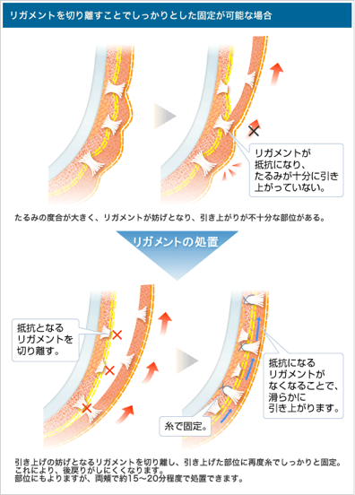 リガメントを切り離すことでしっかりとした固定が可能な場合 リガメントが抵抗になり、たるみが十分に引き上がっていない。 たるみの度合が大きく、リガメントが妨げとなり、引き上がりが不十分な部位がある。 リガメントの処置 抵抗となるリガメントを切り離す。 抵抗になるリガメントがなくなることで、滑らかに引き上げます。 糸で固定 引き上げの妨げとなるリガメントを切り離し、引き上げた部位に再度糸でしっかりと固定。これにより、後戻りがしにくくなります。 部位にもよりますが、両頬で約15～20分程度で処置できます。