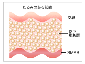 たるみのある状態 皮膚 皮下脂肪層 SMAS