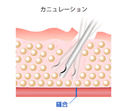 カニュレーション 