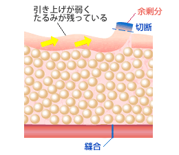 引き上げが弱くたるみが残っている