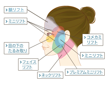 フェイスリフトの種類と適応部位