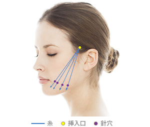 糸 挿入口 針穴