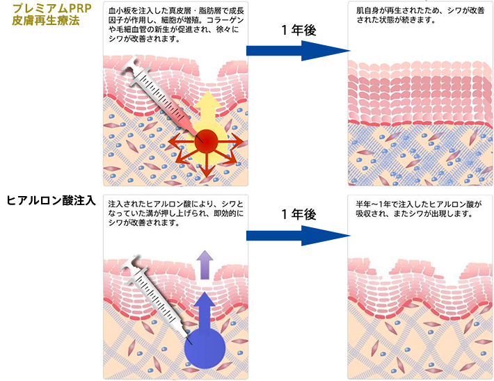 プレミアムPRP皮膚再生療法：血小板を注入した真皮層・脂肪層で成長因子が作用し、細胞が増殖。コラーゲンや毛細血管の新生が促進され、徐々にシワが改善されます。→1年後→肌自身が再生されたため、シワが改善された状態が続きます。　ヒアルロン酸注入：注入されたヒアルロン酸により、シワとなっていた溝が押し上げられ、即効的にシワが改善されます。→1年後→半年～1年で注入したヒアルロン酸が吸収され、またシワが出現します。