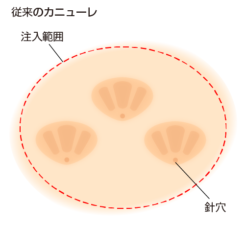 従来のカニューレの注入方法