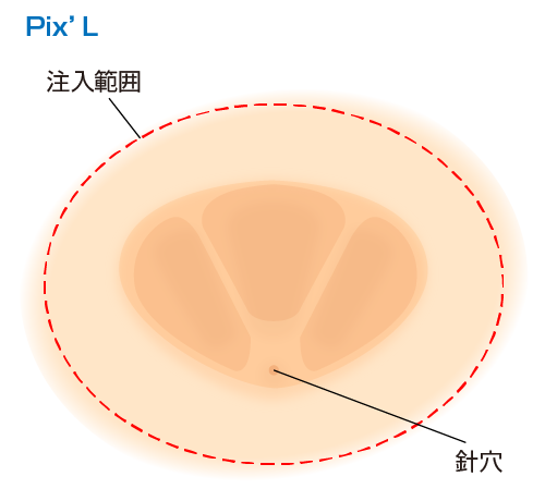 pix'Lの注入方法