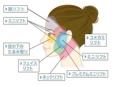 額リフト、ミニリフト、コメカミリフト、目の下のたるみ取り、フェイスリフト、ネックリフト、プレミアムミニリフト