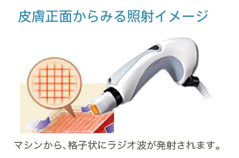 皮膚正面からみる照射イメージ：マシンから、格子状にラジオ波が発射されます。