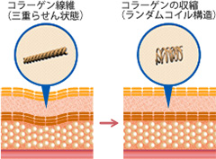 コラーゲン線維（三重らせん状態） コラーゲンの収縮（ランダムコイル構造）