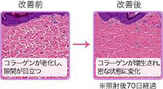 改善前：コラーゲンが老化し、隙間が目立つ→改善後：コラーゲンが増生され、密な状態に変化 ※照射後70日経過