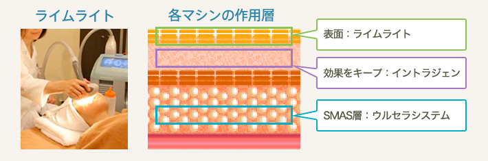 ライムライト 各マシンの作用層 表面：ライムライト 効果をキープ：イントラジェン SMAS層：ウルセラシステム