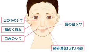 目の下のシワ、頬のくぼみ、唇の縦ジワ、頬のくぼみ、口角のシワ、鼻唇溝（ほうれい線）