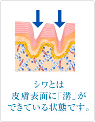 シワとは皮膚表面に「溝」ができている状態です。