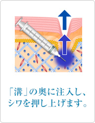 「溝」の奥に注入し、シワを押し上げます。