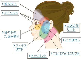 フェイスリフトとは