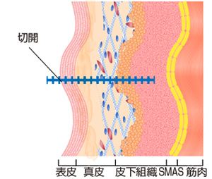 1.皮膚だけではなく、その下の皮下脂肪、SMASもたるんでいる状態。