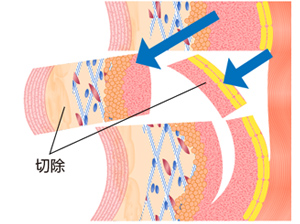 2.皮膚・脂肪組織とともにSMASを引き上げ、余った部分の皮膚とSMASを切除。