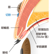 眉下切開法 横から見た図_施術前