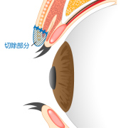 重瞼線部切開法 横から見た図_施術前