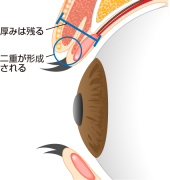 重瞼線部切開法 横から見た図_施術後