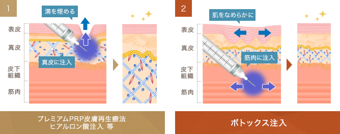 1 プレミアムPRP皮膚再生療法 ヒアルロン酸注入 等 の図 2 ボトックス注入 の図