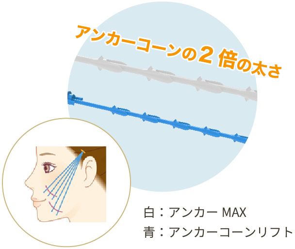 アンカーコーンの2倍の太さの図