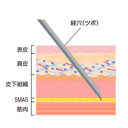 鍼で経穴（ツボ）を刺激する