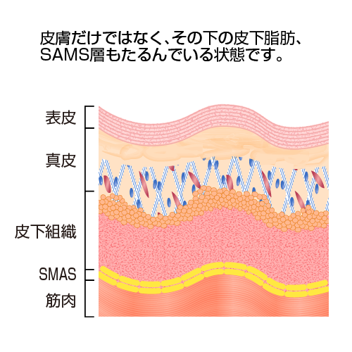 皮膚だけではなく、その下の皮下脂肪、SAMS層もたるんでいる状態です。