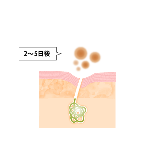 2～5日後