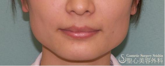 【フェイスライン】ボトックスでえら張りをすっきりと Before 