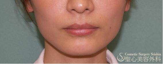 【フェイスライン】ボトックスでえら張りをすっきりと After 