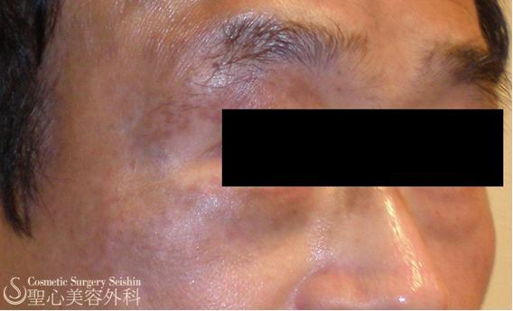 【アザ】太田母斑のレーザー治療 症例写真 美容整形、美容外科なら聖心美容クリニック