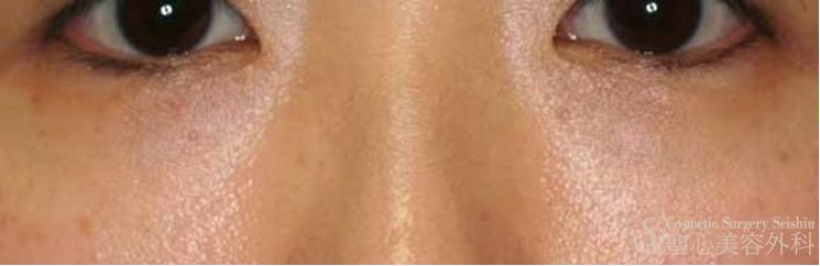 【女性・目元のたるみ】NewPRP皮膚再生療法（2ヶ月後） After 