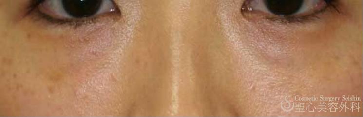 【女性・目元のたるみ】NewPRP皮膚再生療法（2ヶ月後） Before 