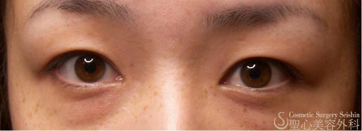 代女性 腫れの少ない麻酔法による二重術 ダブルノット法 症例写真 美容整形 美容外科なら聖心美容クリニック