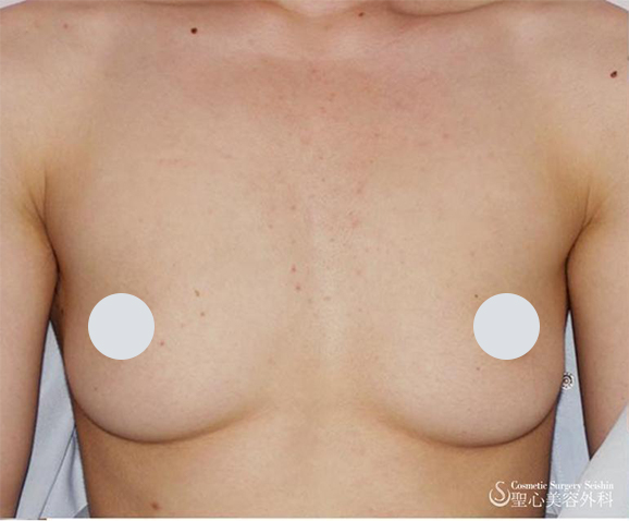 性同一性障害（FTM）、乳腺切除術 Before 