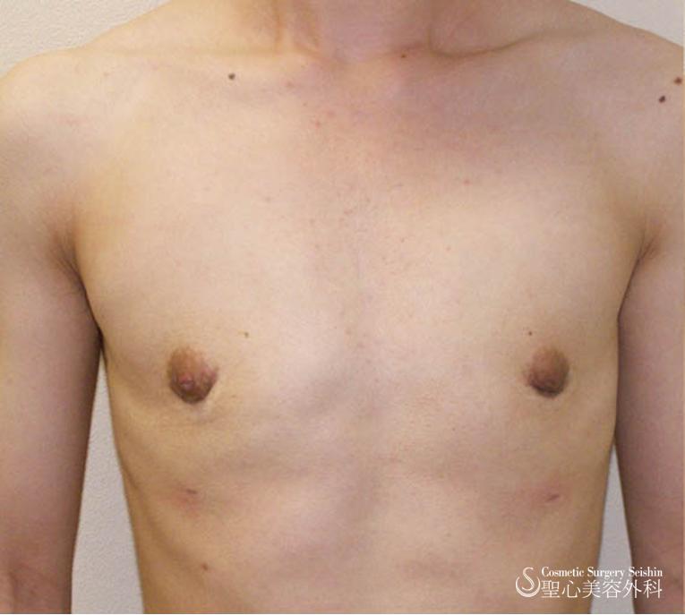 性同一性障害（FTM）、乳腺切除術 After 
