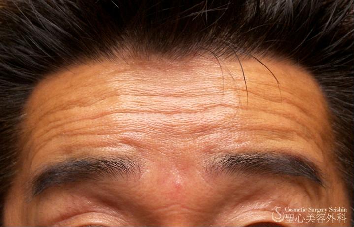 【50代男性・額のシワ】プレミアムPRP単独（1ヶ月後） After 