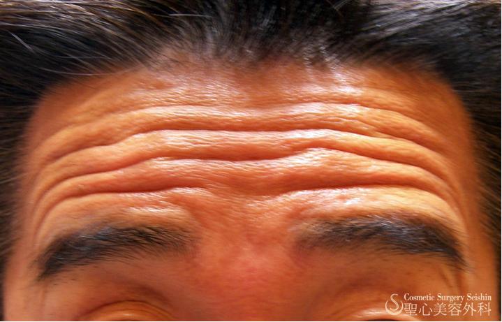 【50代男性・額のシワ】プレミアムPRP単独（1ヶ月後） Before 