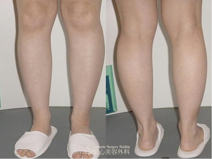 【20代・女性】下腿（ふくらはぎ）脂肪吸引 Before 