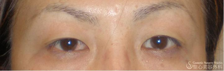 二重　埋没法 Before 