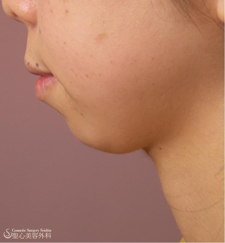 代 女性 メソ サーモセラピー 脂肪溶解注射 二重あご 治療3回後 症例写真 美容整形 美容外科なら聖心美容クリニック