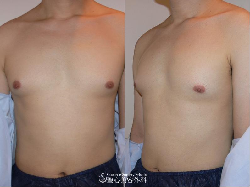 代男性 バストの悩み 女性化乳房 1ヶ月後 症例写真 美容整形 美容外科なら聖心美容クリニック