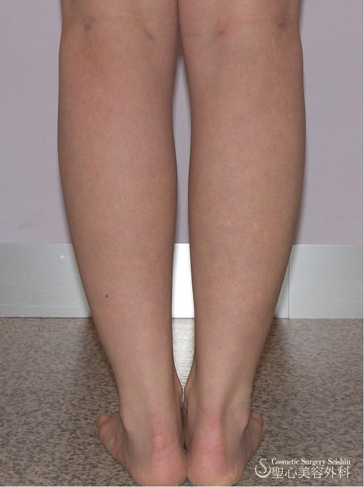 【術後経過】　ふくらはぎ脂肪吸引 After 